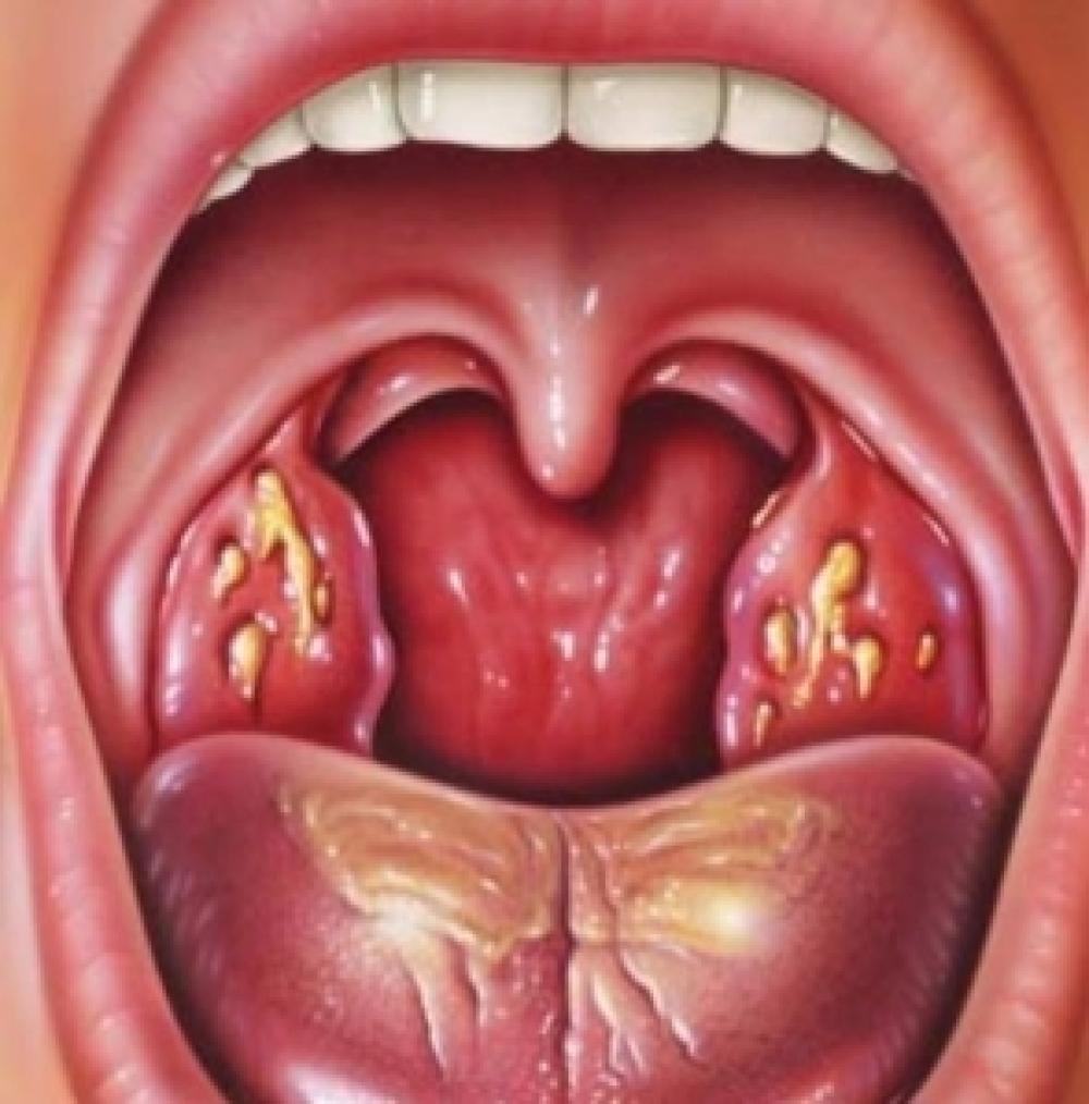Sore Throat / Acute Tonsilitis