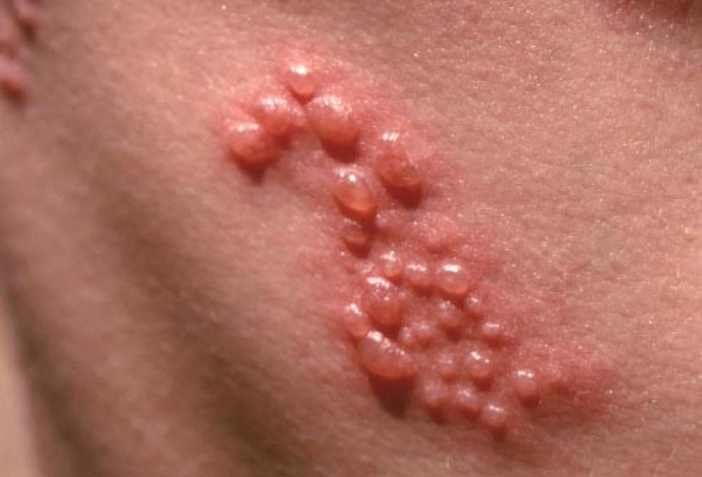 Shingles / Varicella Zoster