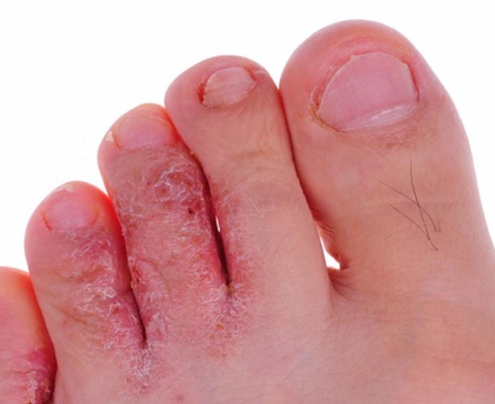 Fungus Infection on Foot