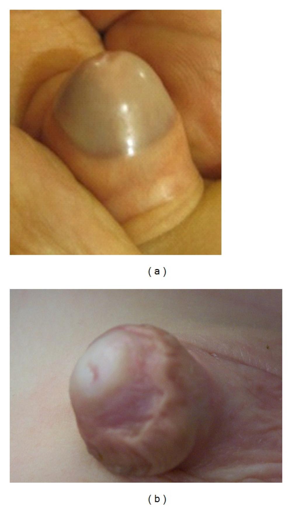  Adhesion of the skin of the neck of the penis to the head of the penis after circumcision