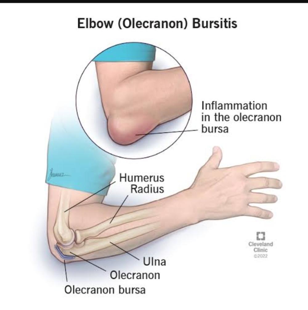 Elbow Bursitis
