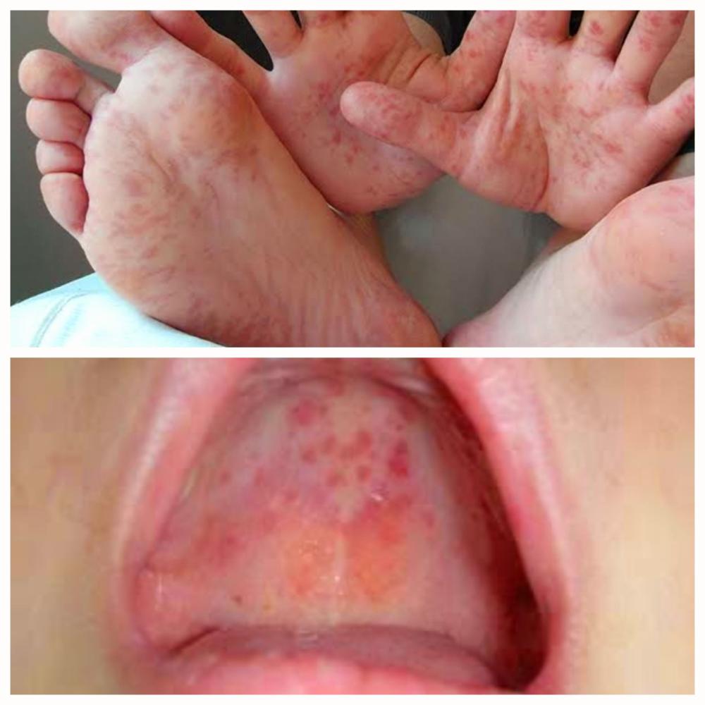 Hand Foot Mouth Disease HFMD